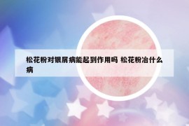 松花粉對(duì)銀屑病能起到作用嗎 松花粉冶什么病