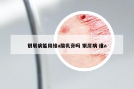 銀屑病能用維a酸乳膏嗎 銀屑病 維a