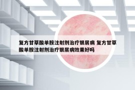 復(fù)方甘草酸單胺注射劑治療銀屑病 復(fù)方甘草酸單胺注射劑治療銀屑病效果好嗎