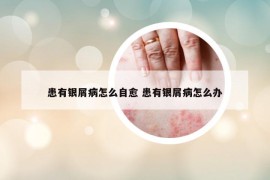 患有銀屑病怎么自愈 患有銀屑病怎么辦