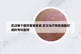 武漢哪個醫(yī)院看銀屑病 武漢治療銀屑病最權(quán)威的?？漆t(yī)院