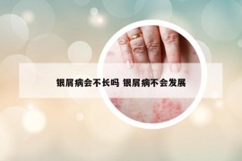 銀屑病會不長嗎 銀屑病不會發(fā)展