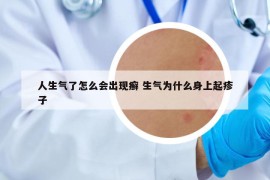 人生氣了怎么會(huì)出現(xiàn)癬 生氣為什么身上起疹子