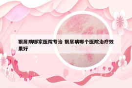 銀屑病哪家醫(yī)院專治 銀屑病哪個(gè)醫(yī)院治療效果好