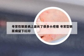 尋常性銀屑病上面長了很多小疙瘩 尋常型銀屑病留下紅印