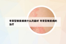 尋常型銀屑病用什么藥最好 尋常型銀屑病的治療