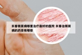長春銀屑病哪里治療最好的醫(yī)院 長春治銀屑病的藥膏有哪些