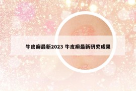 牛皮癬最新2023 牛皮癬最新研究成果