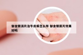 郁金銀消片治牛皮癬怎么樣 郁金銀屑片效果好嗎