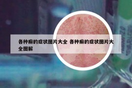 各種癬的癥狀圖片大全 各種癬的癥狀圖片大全圖解
