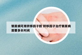 銀屑病可用轉(zhuǎn)移因子膠 轉(zhuǎn)移因子治療銀屑病需要多長時間