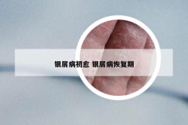銀屑病初愈 銀屑病恢復(fù)期