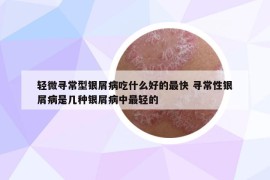 輕微尋常型銀屑病吃什么好的最快 尋常性銀屑病是幾種銀屑病中最輕的