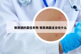 銀屑病的最佳食物 銀屑病最適合吃什么
