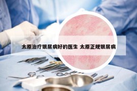 太原治療銀屑病好的醫(yī)生 太原正規(guī)銀屑病