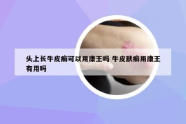 頭上長牛皮癬可以用康王嗎 牛皮膚癬用康王有用嗎