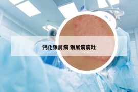 鈣化銀屑病 銀屑病病灶