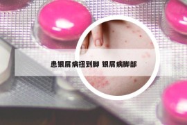患銀屑病扭到腳 銀屑病腳部