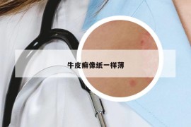 牛皮癬像紙一樣薄