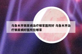 烏魯木齊銀屑病治療哪家醫(yī)院好 烏魯木齊治療銀屑病好醫(yī)院在哪家