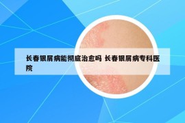 長春銀屑病能徹底治愈嗎 長春銀屑病?？漆t(yī)院