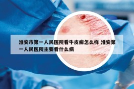 淮安市第一人民醫(yī)院看牛皮癬怎么樣 淮安第一人民醫(yī)院主要看什么病