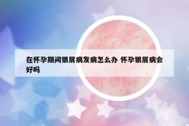 在懷孕期間銀屑病發(fā)病怎么辦 懷孕銀屑病會好嗎