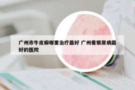 廣州市牛皮癬哪里治療最好 廣州看銀屑病最好的醫(yī)院