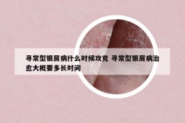 尋常型銀屑病什么時候攻克 尋常型銀屑病治愈大概要多長時間