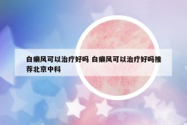 白癩風(fēng)可以治療好嗎 白癩風(fēng)可以治療好嗎推薦北京中科