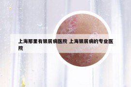 上海那里有銀屑病醫(yī)院 上海銀屑病的專業(yè)醫(yī)院