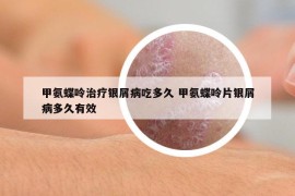 甲氨蝶呤治療銀屑病吃多久 甲氨蝶呤片銀屑病多久有效