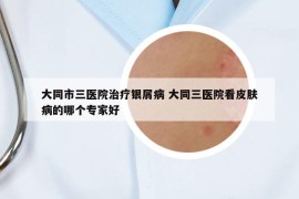 大同市三醫(yī)院治療銀屑病 大同三醫(yī)院看皮膚病的哪個(gè)專家好