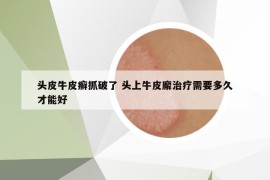 頭皮牛皮癬抓破了 頭上牛皮廨治療需要多久才能好