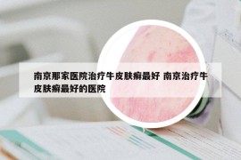 南京那家醫(yī)院治療牛皮膚癬最好 南京治療牛皮膚癬最好的醫(yī)院