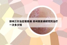 鄭州三針治愈銀屑病 鄭州銀屑病研究院治療一次多少錢