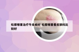 松原哪里治療牛皮癬好 松原哪里看皮膚科比較好
