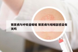 銀屑病與呼吸道喉嚨 銀屑病與咽喉部感染有關(guān)嗎