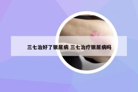 三七治好了銀屑病 三七治療銀屑病嗎