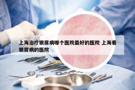 上海治療銀屑病哪個醫(yī)院最好的醫(yī)院 上?？淬y屑病的醫(yī)院