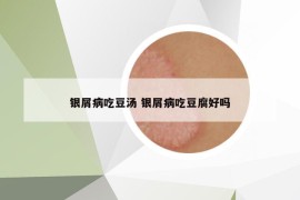 銀屑病吃豆湯 銀屑病吃豆腐好嗎
