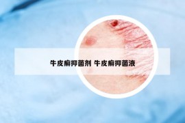 牛皮癬抑菌劑 牛皮癬抑菌液