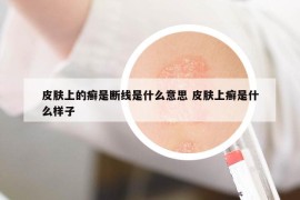 皮膚上的癬是斷線是什么意思 皮膚上癬是什么樣子