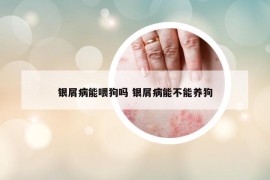 銀屑病能喂狗嗎 銀屑病能不能養(yǎng)狗