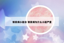 銀屑病小腿會(huì) 銀屑病為什么小腿嚴(yán)重