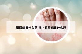 銀屑病用什么藥 腿上銀屑病用什么藥