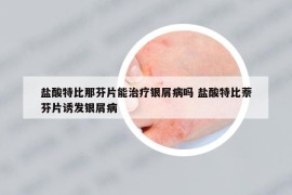 鹽酸特比那芬片能治療銀屑病嗎 鹽酸特比萘芬片誘發(fā)銀屑病