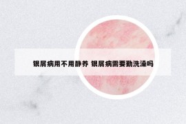銀屑病用不用靜養(yǎng) 銀屑病需要勤洗澡嗎