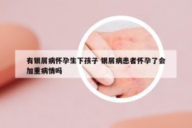 有銀屑病懷孕生下孩子 銀屑病患者懷孕了會加重病情嗎