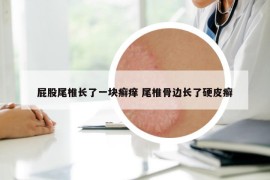 屁股尾椎長了一塊癬癢 尾椎骨邊長了硬皮癬